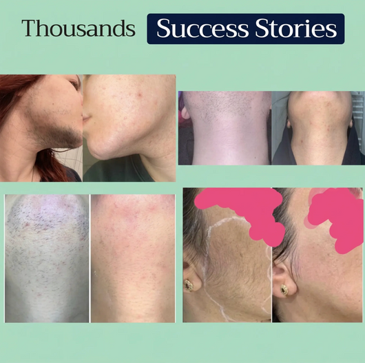 Peakform Thyroid & Liver Support - Stop PCOS Hair Growth From The Root